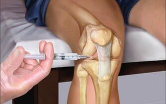 intra-articular injection into the joints for osteoarthritis