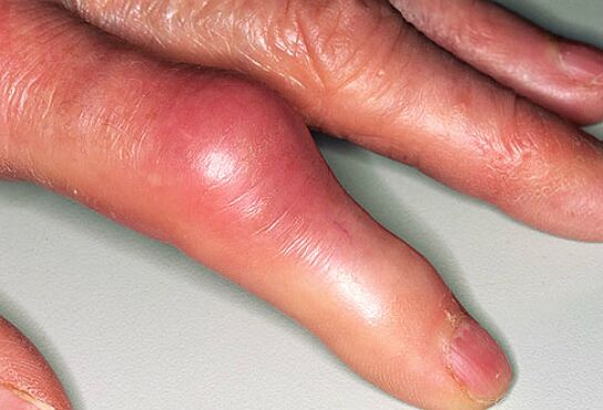 Gout is accompanied by sharp pains in the fingers and swelling of the joints. 