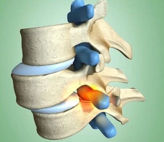 Volatile position of vertebrae