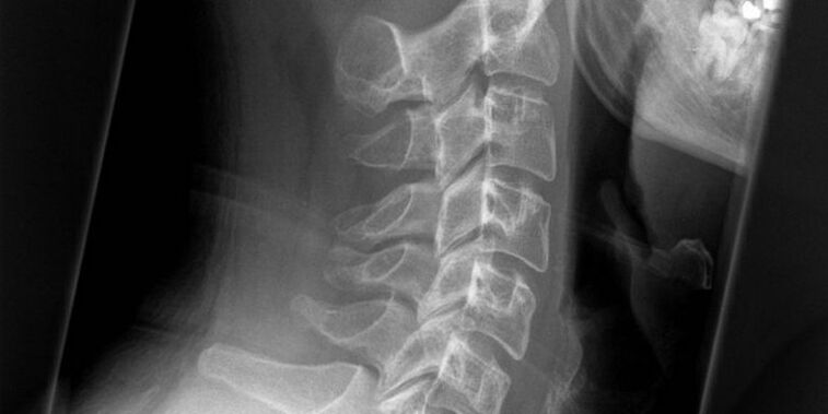 A photograph of the cervical region