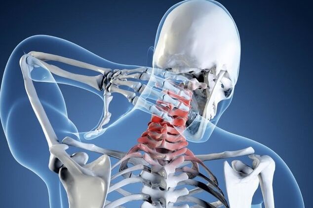 osteochondrosis of the cervical spine